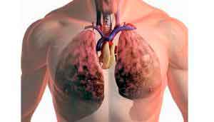 Основные причины болезней органов дыхания