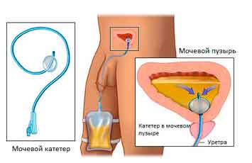 Катетеризация мочевого пузыря у мужчин