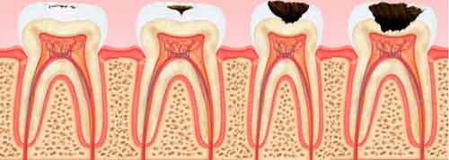 Профилактика кариеса зубов