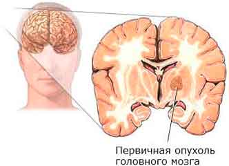 Симптомы рака головного мозга