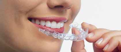 Методы выравнивания зубов