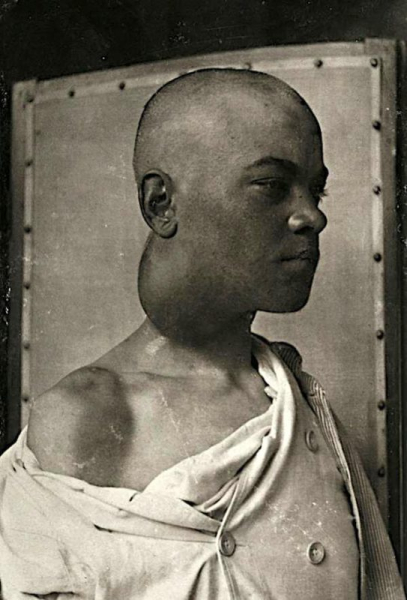 Портреты боли: поразительные фотографии пациентов из XIX века, страдающих от тяжких болезней