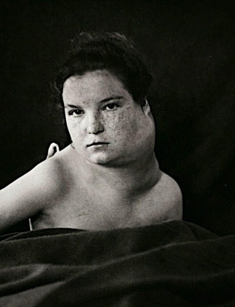 Портреты боли: поразительные фотографии пациентов из XIX века, страдающих от тяжких болезней
