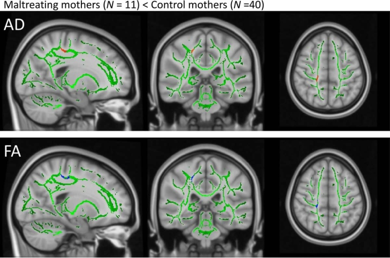 Томография показала особенности в мозге жестоких матерей