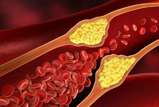 Кардиолог Проваторов: «плохой» холестерин может быть полезным организму