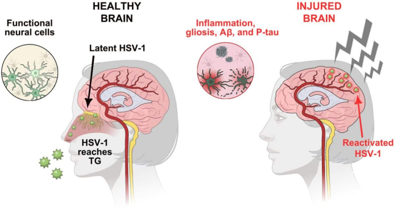 Ученые объяснили, как травмы головы могут запускать болезнь Альцгеймера через вирус герпеса